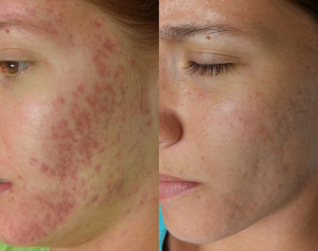 Female acne scarring before and after SkinPen